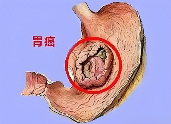 胃癌, 为何一发现就是中晚期? 身体给的5次机会, 很多人没当回事
